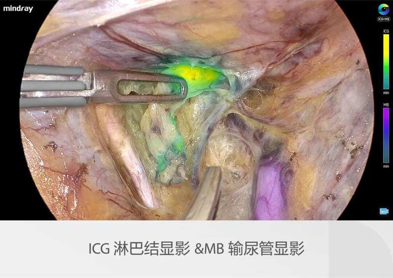  迈瑞全域荧光智能影像平台，探索精准外科未达之“镜” 新闻