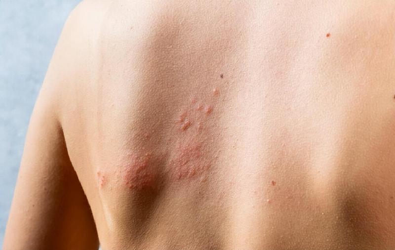  长寿时代：免疫稳态与带状疱疹的博弈洞察 健康养生