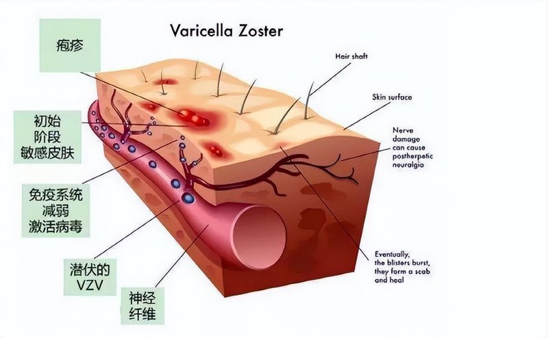  长寿时代：免疫稳态与带状疱疹的博弈洞察 健康养生
